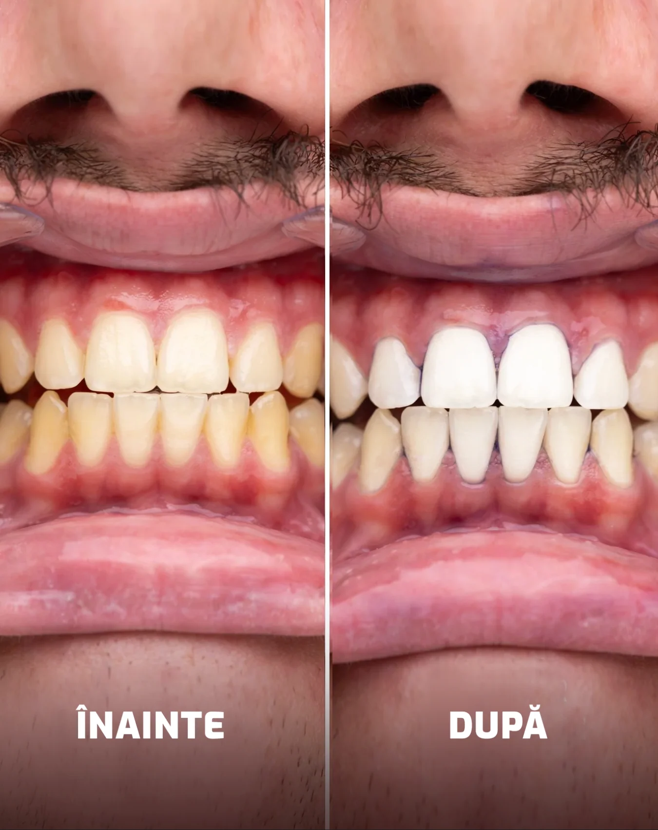 Benzi de albire a dinților - Mov - Image 3